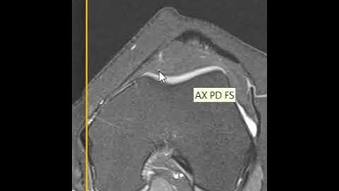 Lateral patellar subluxation