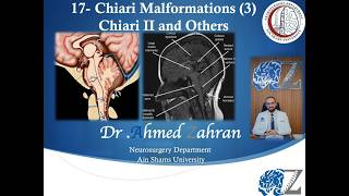 Congenital (17): Chiari Malformations (3): Chiari II and Others