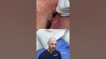 This ULTRA Painful Eye Stye Will Make You Gasp Stye Dermreacts Skincare Dermatology 