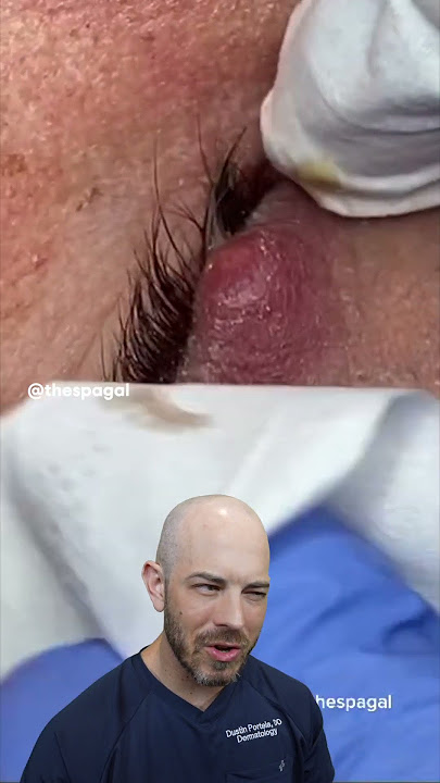 This ULTRA painful eye stye will make you gasp! 🫢 #stye #dermreacts #skincare #dermatology