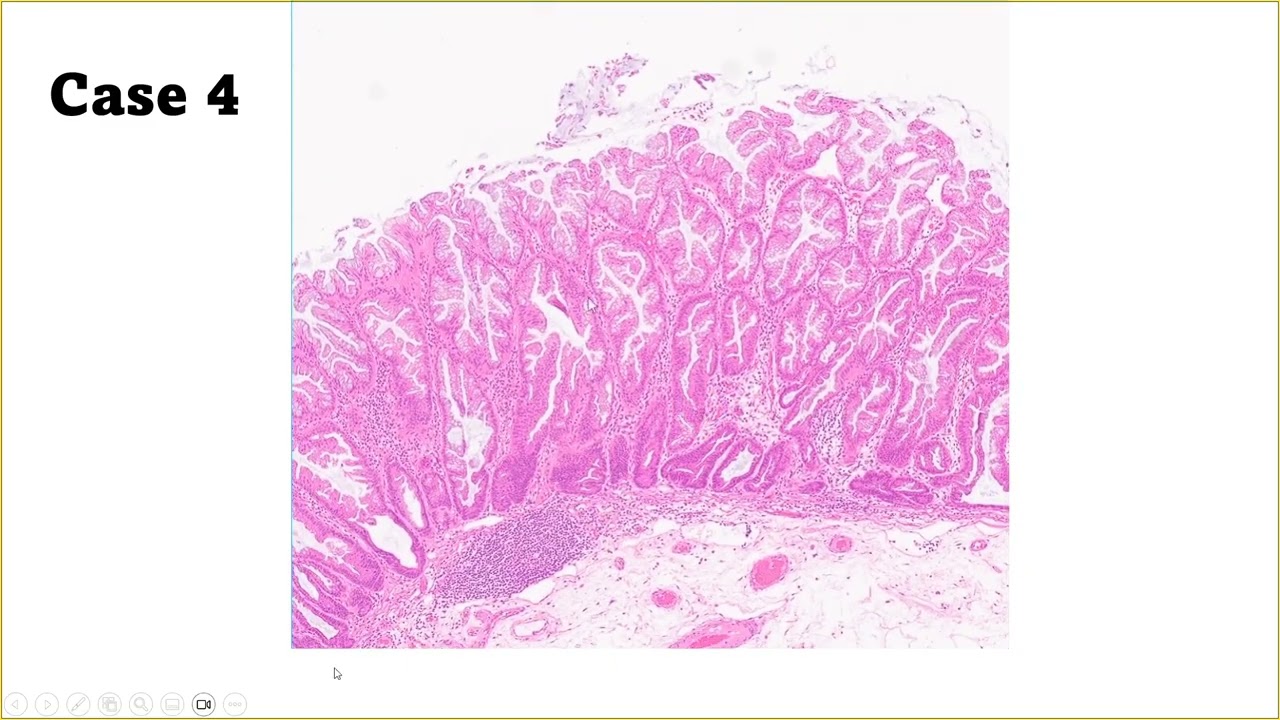Case (LI 4): Sessile Serrated Lesion