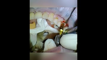 Versah osseodensification for sinus floor elevation