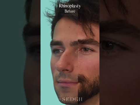 Male Rhinoplasty Before