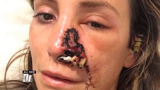 Woman's Pimple Turns Out To Be Cancer - Dr. Kian Karimi on The Doctors