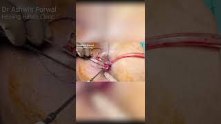 Can anal fistula &amp; abscess be treated together ? Yes with Dr Porwal Laser DLPL @Healing Hands Clinic