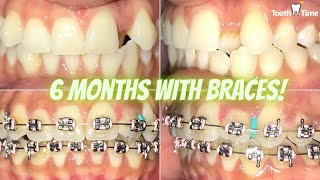 Braces Checkups - 6 months progress GREAT Results- Tooth Time Family Dentistry New Braunfels Texas