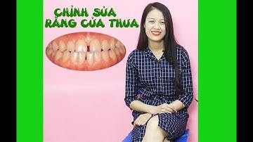 Sửa Răng Cửa Thưa -   Phương pháp dán sứ veneer