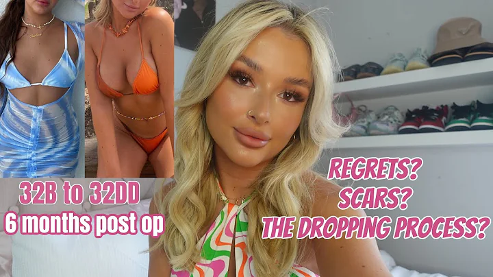 SIX MONTH POST-OP BREAST AUGMENTATION Q&A THINGS I...