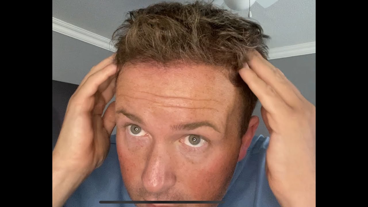 HAIR TRANSPLANT 6 MONTH UPDATE