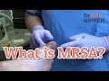 Toe Infection with MRSA. What is MRSA? (2022)