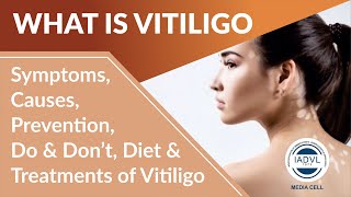 What is Vitiligo | Symptoms, Causes, Prevention, Diet & Treatments-By Dr. Jagdish Sakhiya ( Hindi )