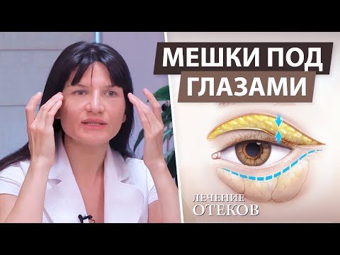 Как убрать мешки под глазами ( отеки / круги / синяки )