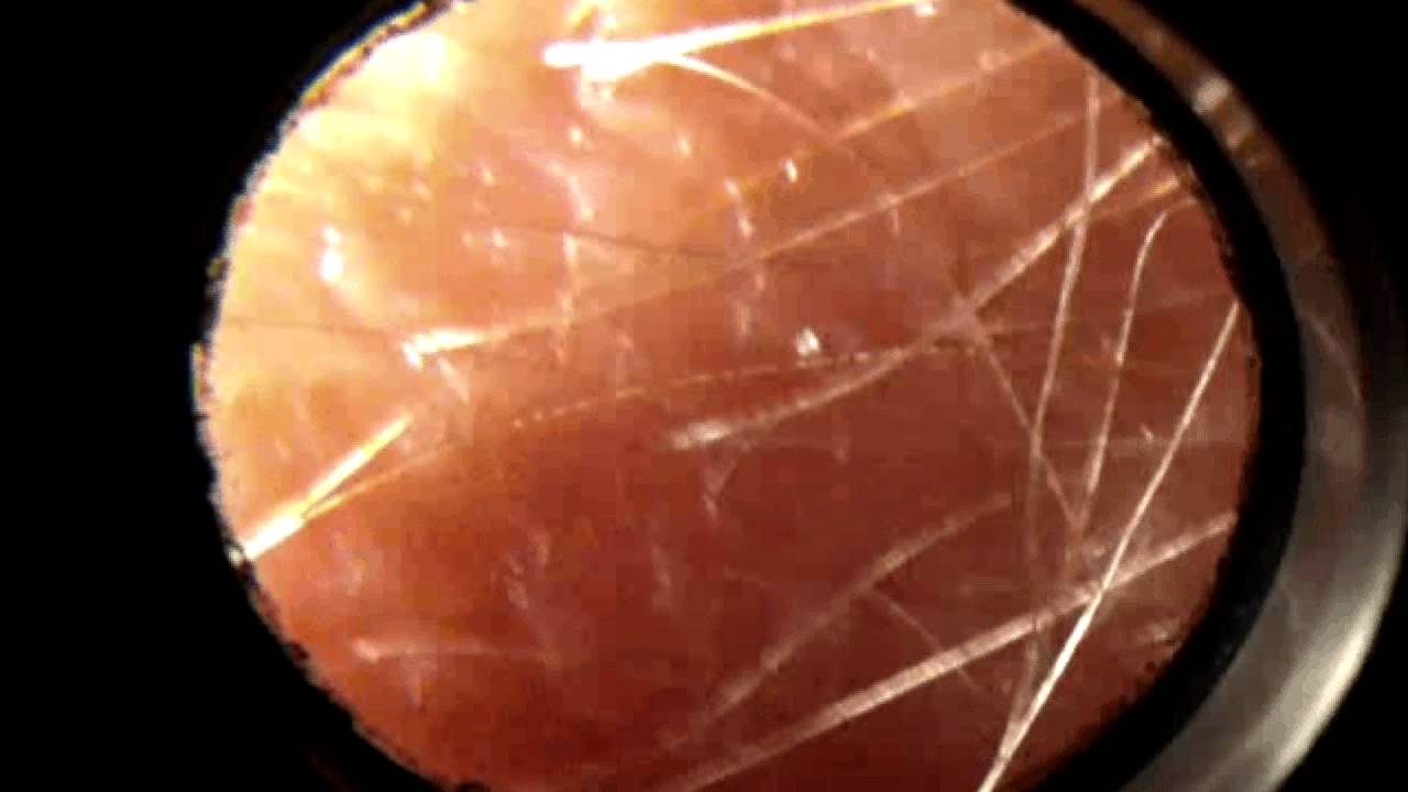 Insect Turcher Insects on my body @ 10X timothytrespas morgellons sickness bug torture ...