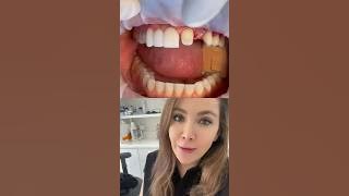 Dental Bridge For Front Teeth!