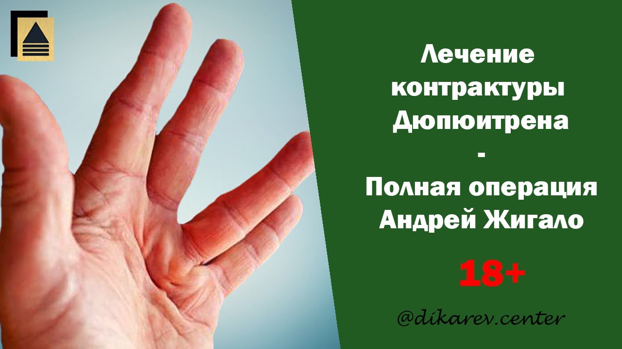 Полная операция - лечение контрактуры Дюпюитрена - 18+ - YouTube