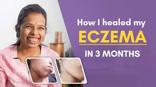How I Healed My Eczema In Just 3 Months