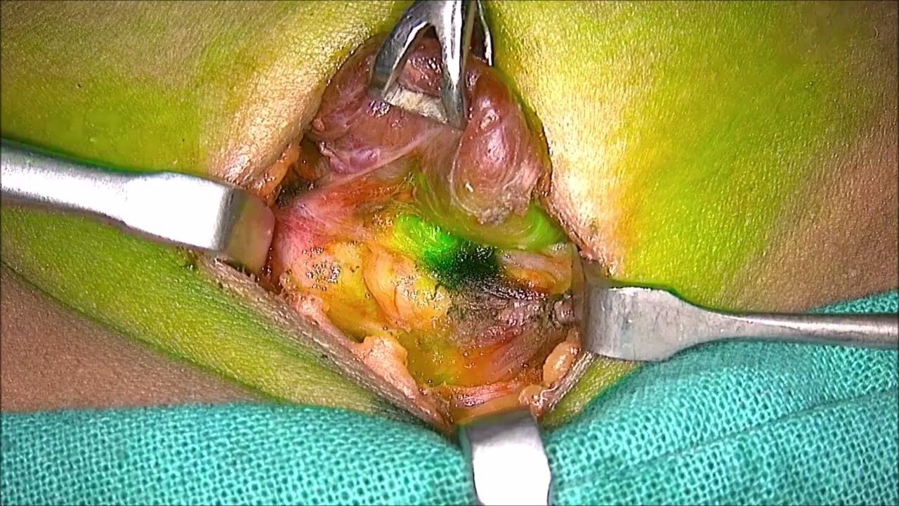 Intra-Operative Indocyanine Green Angiography for Parathyroidectomy by Dr Vipin Goel