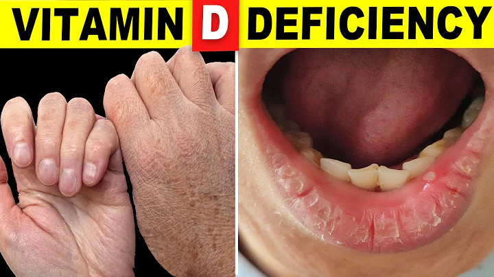 10 signes que votre corps a besoin de vitamine D