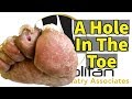 A Hole In The Toe: A Hidden Ulcer Under A Callus