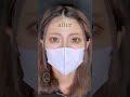 【二重整形】のビフォーアフター!可愛すぎる変化を公開