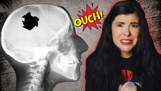 The Chilling History of Drilling Holes in Your Skull...