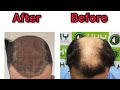 Hair transplant reshad delawar khan