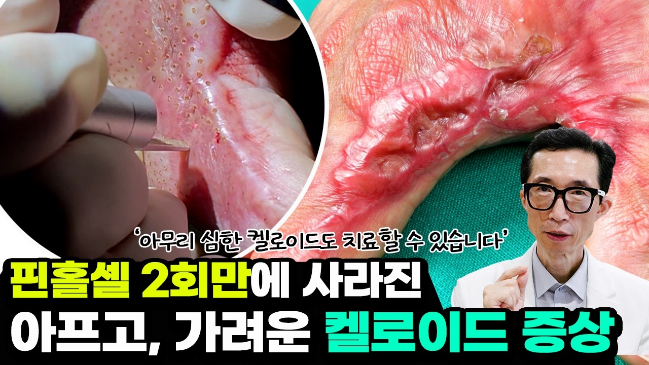 정말 심했던 켈로이드 흉터,????핀홀셀 치료 과정을 공개합니다????