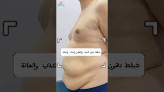 شفط دهون البطن والظهر والثدي والعانة transition