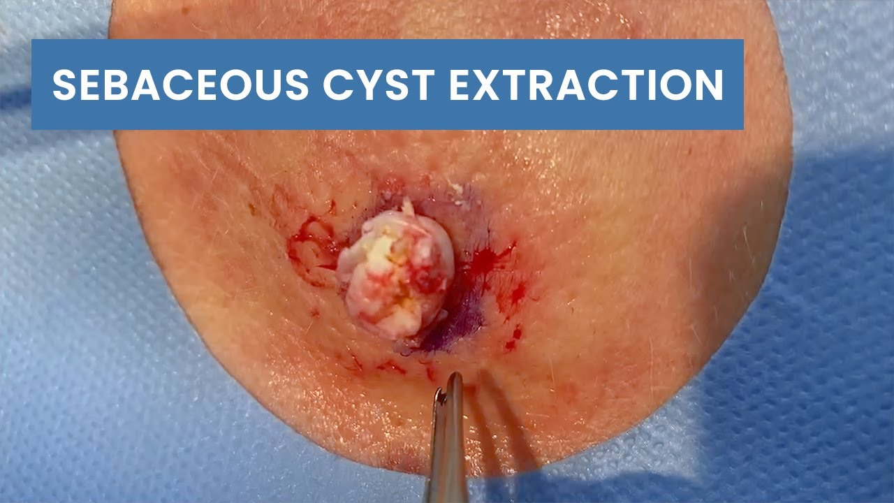 Lancing a Sebaceous Cyst