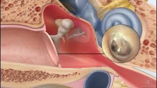 Repair a perforated ear drum using ClearDrum