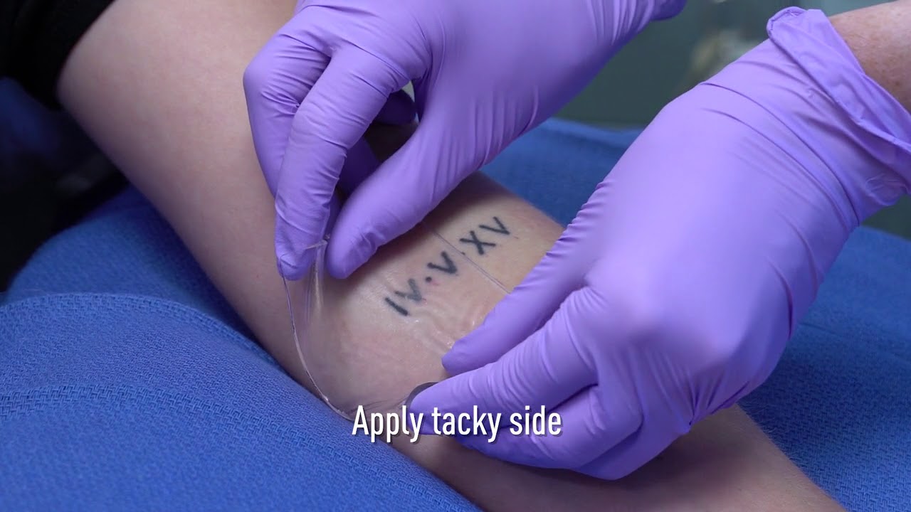 Describe PFD Patch  Connecticut Tattoo Removal