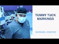 Mommy Makeover (Graphic) - Tummy Tuck Markings and Pre-Surgery