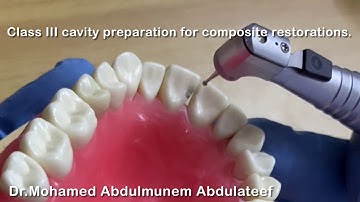 Class III cavity preparation for composite restoration of maxillary central incisor.