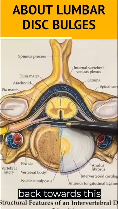 about-bulging-disc-l4-l5-disc-bulge-l5-s1-disc-bulge-dr-walter