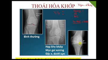 Cơ Xương Khớp   Chẩn đoán hình ảnh Xquang   Thoái hóa khop