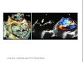 Dr Jason Kaplan: 3D Echocardiographic Assessment of Mitral Valve Disease