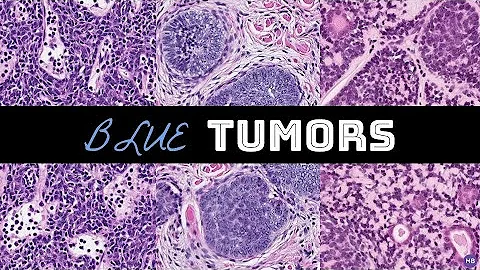 Blue Adnexal Tumors: Unknown Cases + Discussion | ...