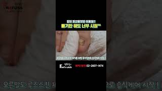 깊이 파고들었던 발톱 조각 이물질!!! 빼기만 해도 너무 시원.. #레푸스 #refuss #내성발톱 #무좀발톱 #발톱 #toenail #ingrown_toenail_surgery