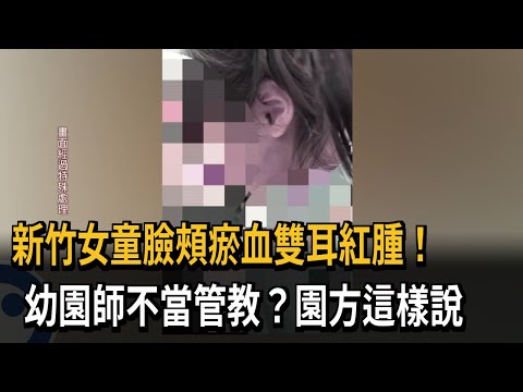 新竹女童臉頰瘀血雙耳紅腫！ 幼園師不當管教？園方這樣說－民視新聞