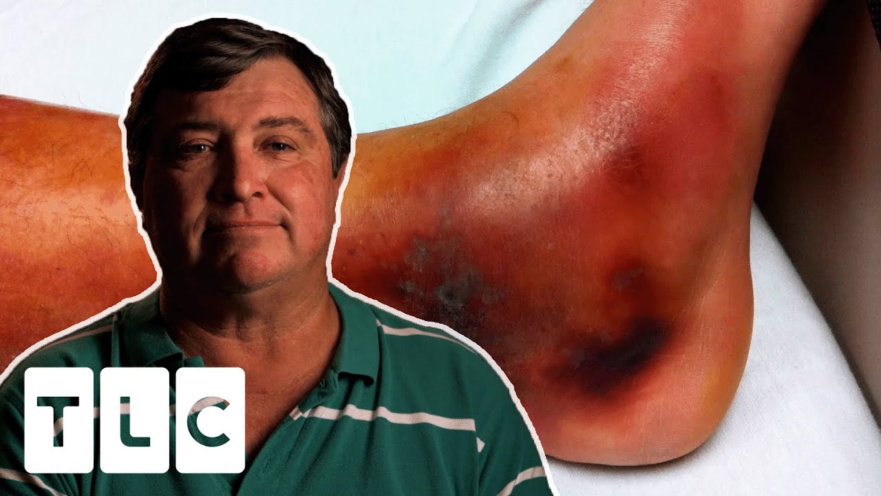 Flesh Eating Bacteria Could Cause Man To Lose His Leg! | Monsters Inside Me