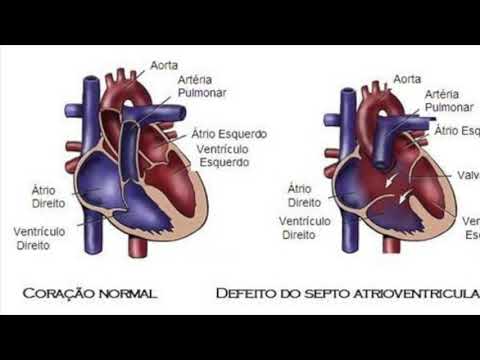 Vídeo: Defeito Cardíaco Congênito (defeito Do Septo Atrial) Em Gatos