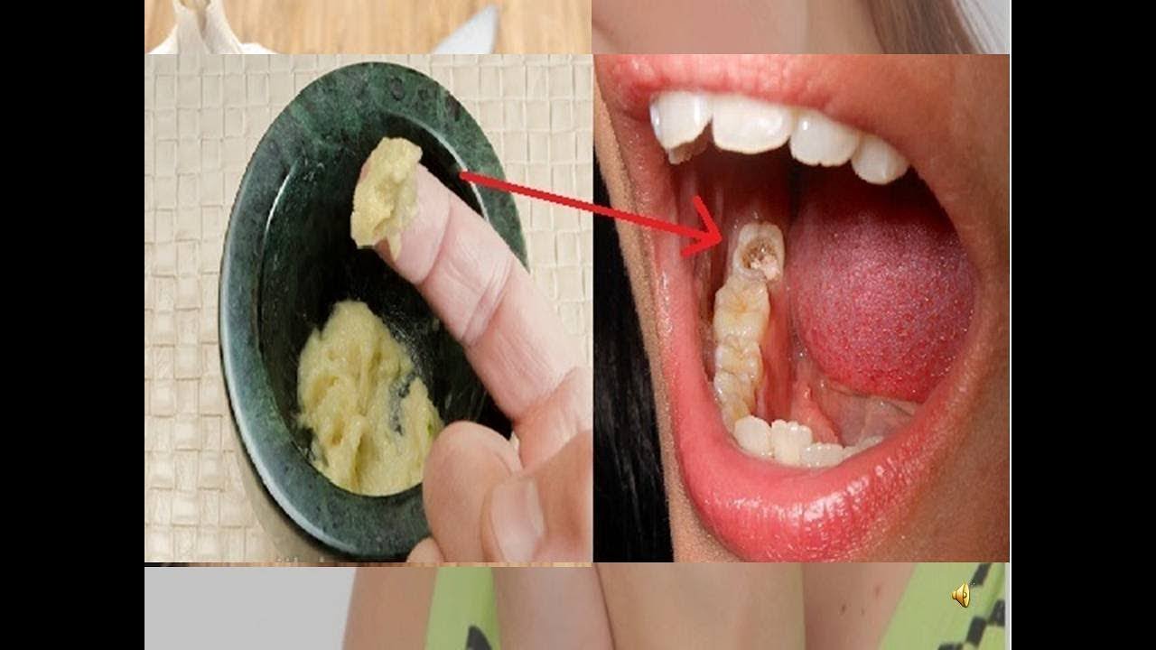 Sakit Gigi Hilang Hanya Dengan Bawang Putih