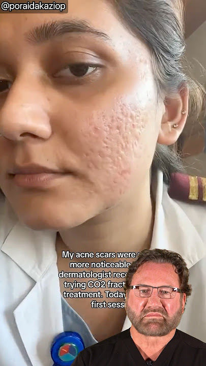 CO2 Laser for Acne Scars - Surgeon Reacts