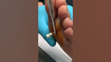Thumbnail of Did you know podiatrists can fix broken bones? #shorts