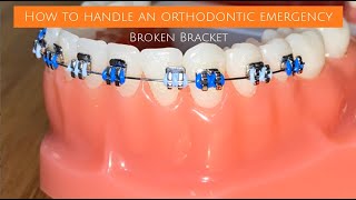 Handling An Orthodontic Emergency: Broken Bracket