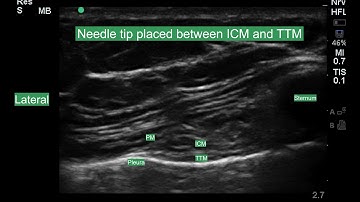 Transversus Thoracic Plane Block