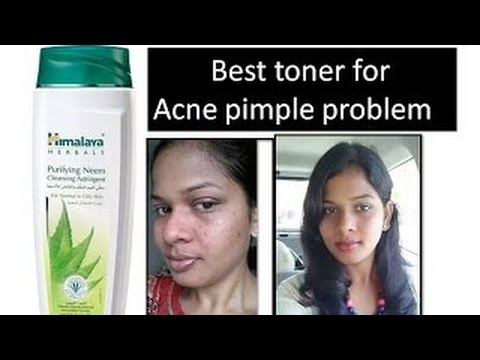 Best toner to clear Acne pimples | Get clear skin |Himalaya Herbals purifying Neem Toner|