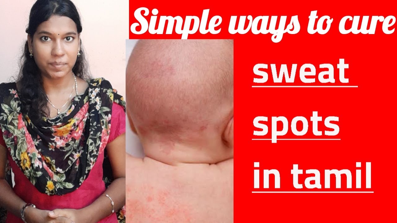 வேர்க்குருவை போக்குவதற்கான ஆக சிறந்த வழிமுறைகள்summer careHow to