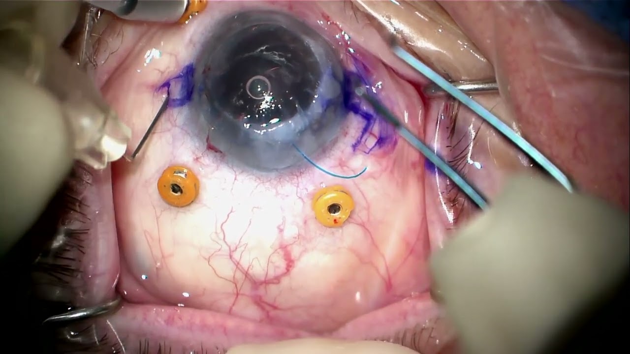 Exchange of lens on retina for Yamane AR40 combined with PK by Steven G. Safran MD