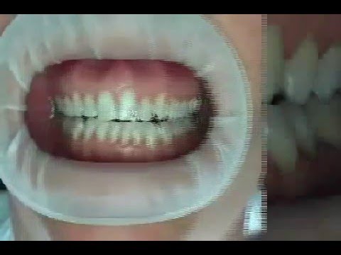Was ist Zahnschmuck und wie wird er befestigt